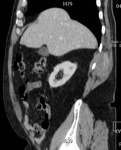 CT scan abdomen (extern) : Inhomogeen aankleurende massa