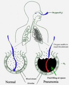 oropharynx en maag - inhaleren van aërosols