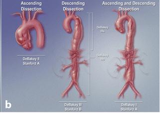 Fig 3: De Stanford classificatie van de aortadissecties.