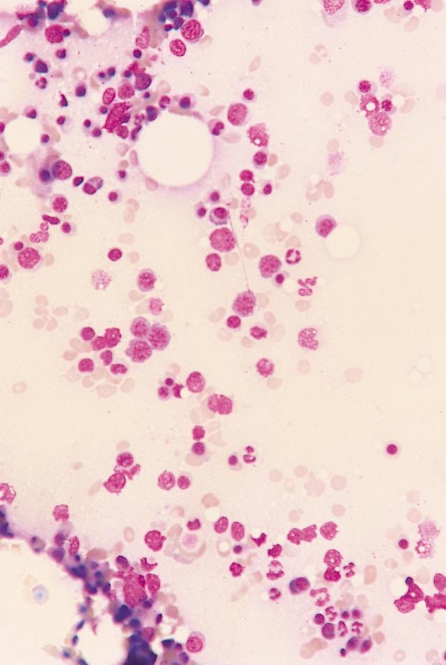 megaloblasten bleke erytrocyten Cristabiopt van patiënt A met als bevinding ijzergebrek en sterk overheersende megaloblastaire rode reeks. De aangetroffen volwassen erytrocyten hebben een bleke kleur.