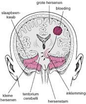 andere compartiment. Tentorieel: Mesencephalon komt in de knel.