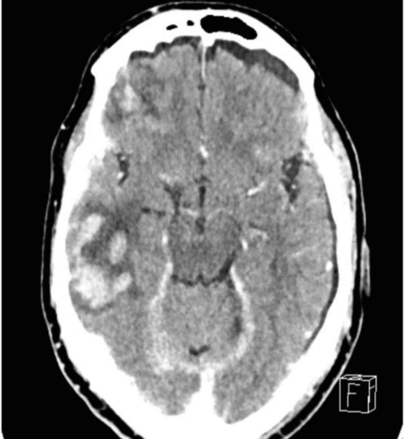 CT hersenen Bilateraal subduraal hematoom Bilateraal
