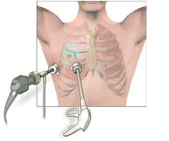 Video Assisted Thorascopical Surgery (VATS): een kijkoperatie waarbij slechts enkele kleine sneetjes in uw borstkas