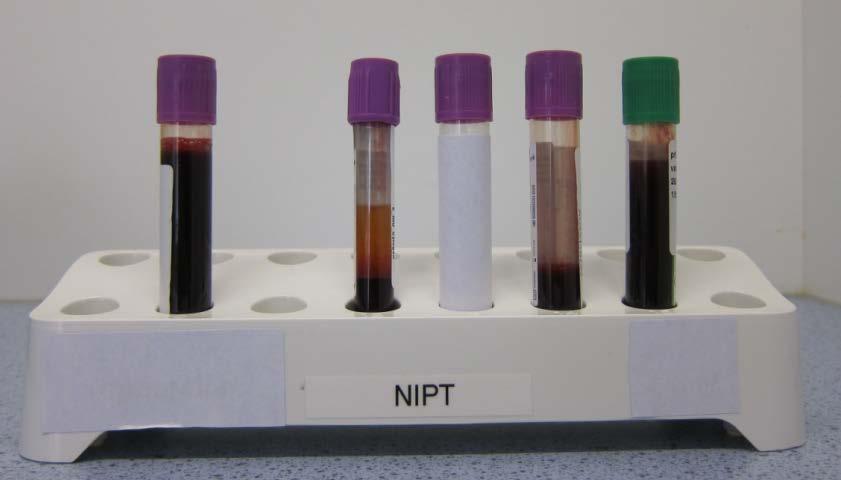 7. Afname en verzenden materiaal voor NIPT Bloed voor NIPT wordt afgenomen op maandag en dinsdag voor 12:00 uur. Zie bijlage 1 voor de afnamedagen.