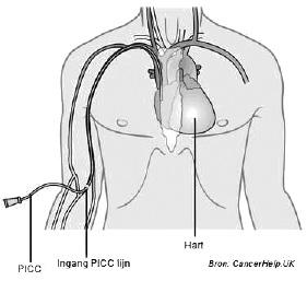 De Perifeer Ingebrachte Centrale Catheter (PICC) Met u is gesproken over de mogelijkheid om een PICC in uw bovenarm te plaatsen.
