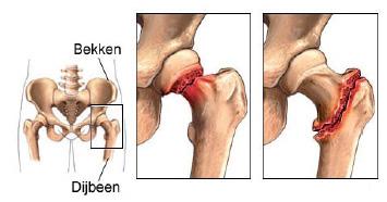 Inleiding De arts stelt voor een operatie aan uw heup uit te voeren omdat deze is gebroken. In deze folder geven wij hierover informatie. Uw arts bespreekt een aantal zaken uit deze folder met u.