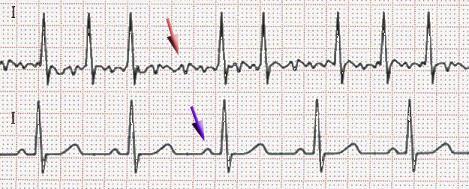 Oorzaak: Voorkamerfibrillatie Onregelmatig hartritme