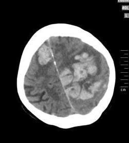 Intracraniële bloedingen % 9 8 7 6 5 4 3 2 1 0 7.7 Warfarin Dabigatran 110 mg 3.85 0.