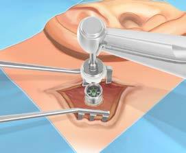 22) Plaats het implantaat axiaal op het gat en begin met het inbrengen van het implantaat. Begin met irrigeren als het eerste schroefdraad het bot is binnengegaan. (Fig.