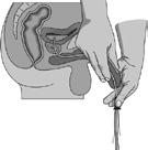 Laat de katheter zitten tot er geen urine meer uit de blaas loopt. Voorkom urineweginfecties door er iedere keer voor te zorgen dat uw blaas volledig leeg is.