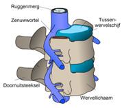 04 DE TRANS- FORAMINALE EPIDURALE INFILTRATIE Een epidurale infiltratie is een inspuiting van een product in de epidurale ruimte.