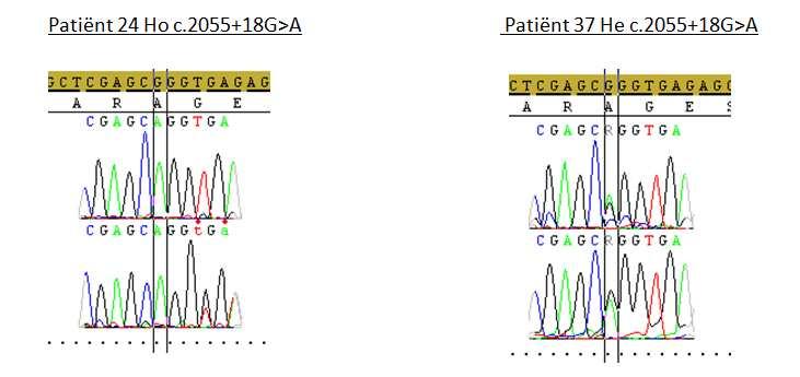 Resultaten 4.1.5 Bespreking genvariaties 4.1.5.1 Splice site mutatie c.2055+18 G>A Twee patiënten vertonen de mutatie c.2055+18g>a. Patiënt 24 in homozygote en patiënt 37 in heterozygote vorm.