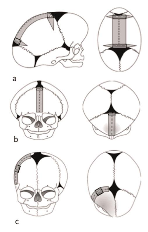 Figuur 1: Endoscopische stripcraniëctomie: het grijze areaal geeft de omvang van de craniëctomie weer bij a: scafocefalie, b: trigonocefalie en c: rechtsfrontale plagiocefalie. lage mortaliteit had.