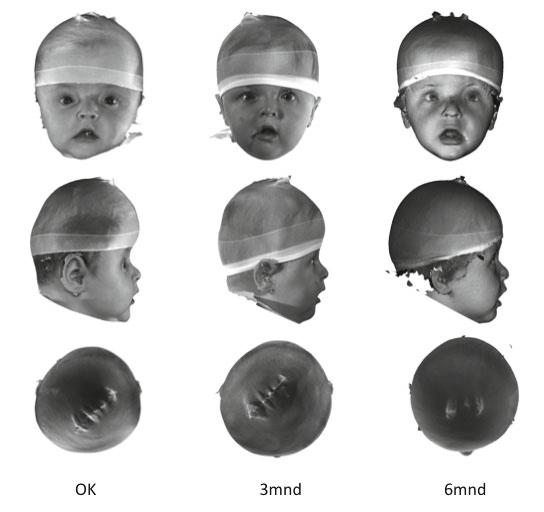Bij scafocefalie werd pre- en postoperatief de cefale index (CI, breedte schedel/lengte schedel) vastgelegd om het resultaat van de behandeling enigszins te kunnen objectiveren.