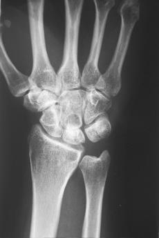 Afbeelding 1: Röntgenfoto van een gezonde rechter pols.