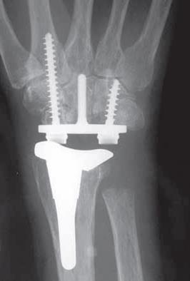Tijdens de operatie worden een aantal handwortelbeentjes gedeeltelijk verwijderd, zodat de prothese in de pols past.