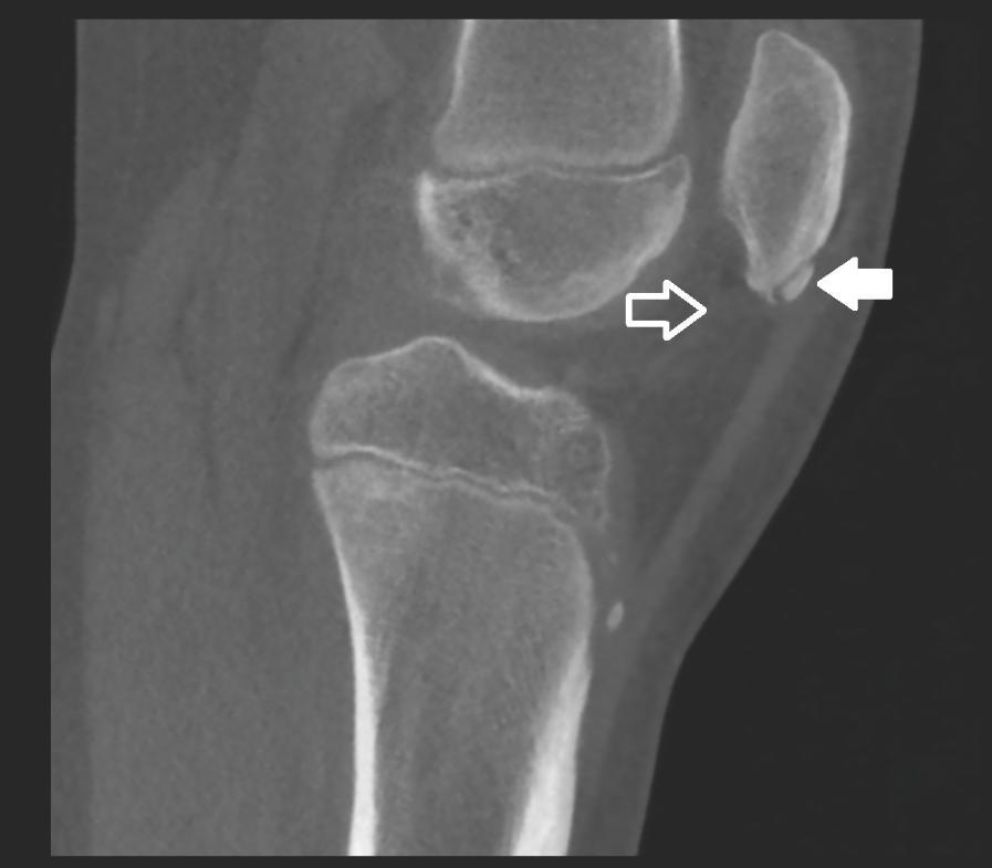 Figuur 1C: Sagittale snede van conebeam-ct-onderzoek van de knie.