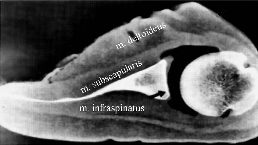 5 1 2 3 4 Figuur 11 CT-scan van een preparaat van de rechter schouder met luchtvulling van de gewrichtsholte 1. labrum glenoidale 2. humerus 3. sulcus intertubercularis 4. collum anatomicum 5.