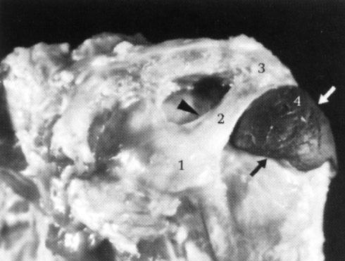 Figuur 13 A Preparaat van de linker schouder met opgespoten bursa subacromiale en subdeltoidea- m. infraspinatus 1. processus coracoïdeus 2. lig. coracoacromiale 3. acromion 4.