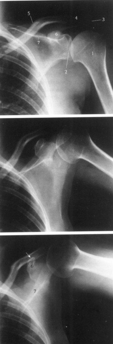 Figuur 29 Röntgenfoto's gemaakt tijdens passieve anteflexie bij patiënt met een primaire frozen shoulder A. ruststand B. 70 anteflexie C.