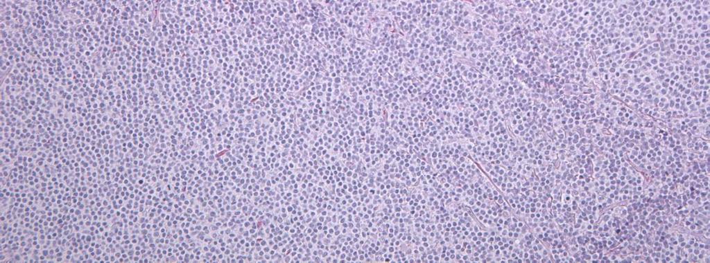 laaggradige B-cell lymfomen 1993: In alle