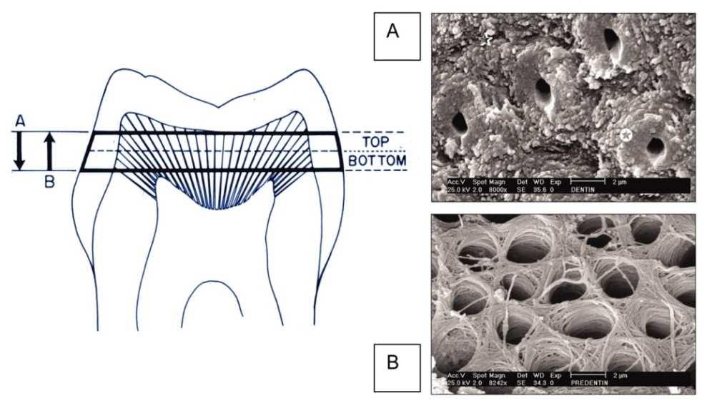 meer opengezet waardoor het tubulair vocht afkomstig van de pulpa vlotter naar het dentineoppervlak kan vloeien (21, 23-25). Figuur 1.