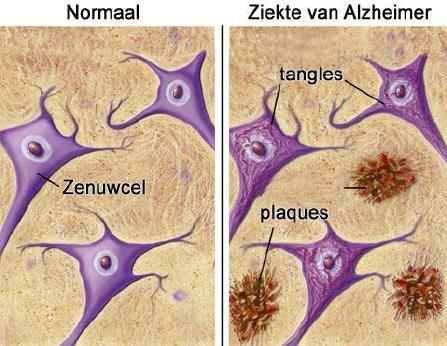 De verkeerd gevouwen eiwitten bij de ziekte van Alzheimer Bij patiënten die lijden aan de ziekte van Alzheimer zorgt een te stabiel eiwit in de hersenen voor problemen omdat het niet afgebroken kan