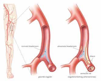 Claudicatio intermittens De oorzaak van claudicatio intermittens is slagaderverkalking (atherosclerose) in de benen.