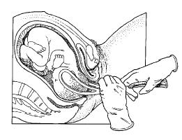 Een vaginale kunstverlossing: verlostang of vacuüm Een vaginale kunstverlossing is een bevalling via de vagina (schede), waarbij de gynaecoloog met een verlostang of een vacuümpomp helpt bij de