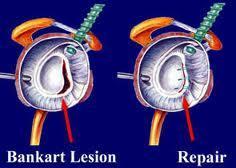 De operatie Tijdens deze operatie (die zowel via een insnede als via een kijkoperatie kan uitgevoerd worden) wordt het afgescheurd ligament met enkele botkrammetjes (ankers) terug vastgehecht aan het