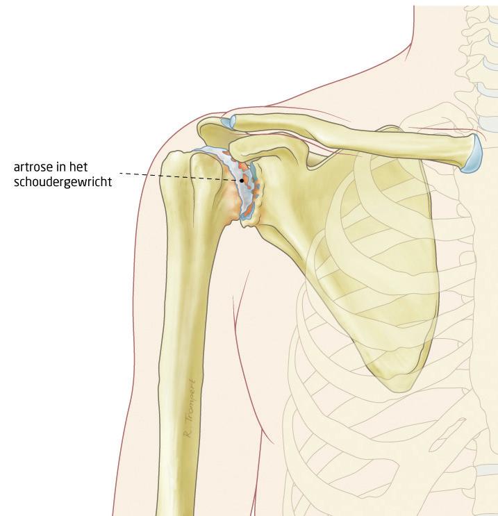 Aandoening Wat is schouderartrose? Kraakbeen zorgt ervoor dat botten soepel langs elkaar kunnen glijden, het zorgt ervoor dat gewrichten soepel en pijnloos kunnen bewegen (zie afbeelding 1).