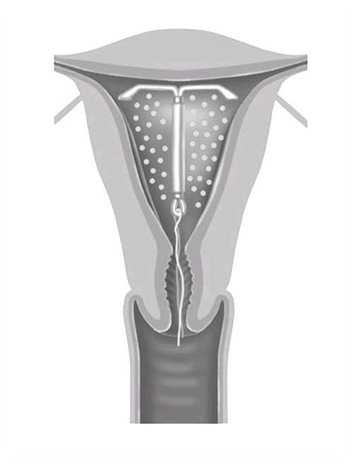 Hormoonspiraal Het hormoonspiraal wordt net als een koperspiraal in de baarmoeder ingebracht en kan 5 jaar blijven zitten.