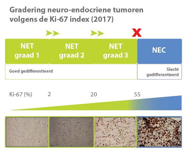 Gradering, stadium en complicaties bij NET Een graad 3 tumor deelt veel sneller dan een graad 1 en 2.