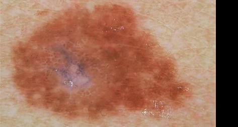 De moedervlek werd verwijderd en er werd een beginnend melanoom (kwaadaardige moedervlek) gevonden door middel van weefselonderzoek.
