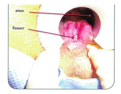 In overleg met uw chirurg wordt u binnenkort in het Rode Kruis ziekenhuis behandeld voor een zogenoemde anaal fissuur. Dit is een kloofje of scheurtje van de anus.