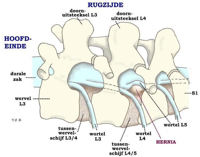 De weke kern van de tussenwervelschijf kan gaan uitpuilen wanneer de stevige omhulling een zwakke plek vertoont of scheurt. We spreken dan van een 'hernia nuclei pulposi' (HNP), afgekort tot 'hernia'.