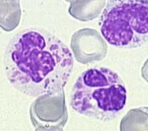 abnormale neutrofielen cytoplasma toxische korreling Alder granulatie Chédiak-Higashi