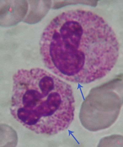 abnormale neutrofielen cytoplasma toxische korreling Alder granulatie Chédiak-Higashi vacuolisatie Döhle bodies May-Hegglin hypogranulatie