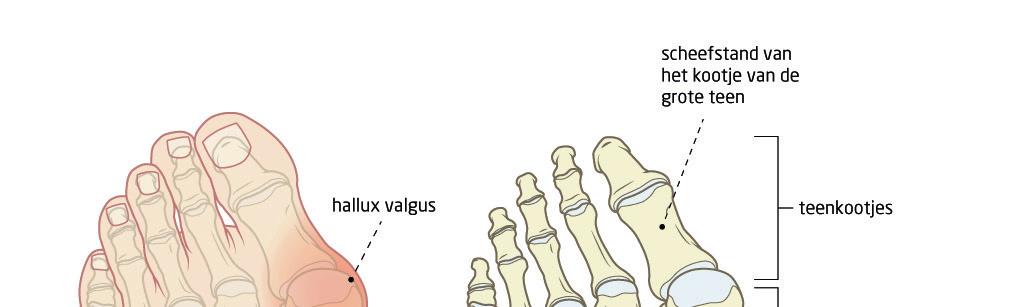 Hallux valgus U heeft een aandoening aan de grote teen. Deze folder geeft informatie over de aandoening en de behandeling. Aandoening Wat is hallux valgus?