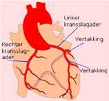 02. De kransslagaders en vernauwingen De kransslagaders liggen op het hart en brengen zuurstof en voedingsstoffen naar de hartspier. We hebben 2 kransslagaders: een linker en een rechter.