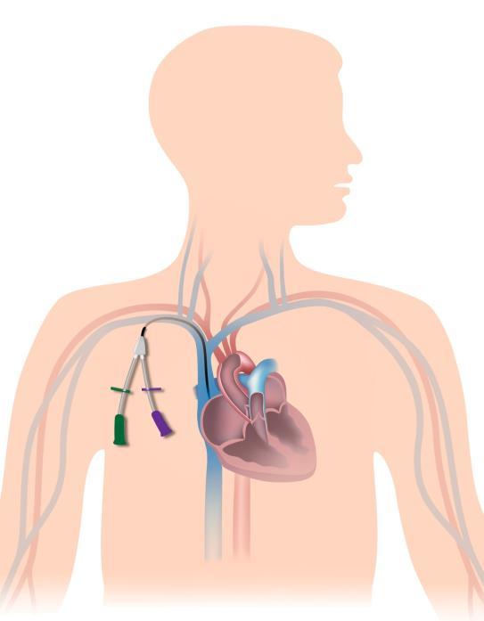 Inleiding In overleg met uw arts is besloten dat u centraal veneuze catheter (CVC) krijgt. Dit wordt ook wel een centrale lijn of lange lijn genoemd.