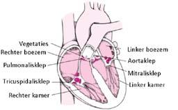 Afbeelding 1 Wat is bacteriële endocarditis? Endocarditis is een ontsteking van de binnenwand van het hart, endocard, en de hartkleppen die gevormd zijn uit de plooien van het endocard.