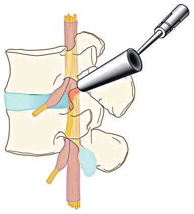 De operatie Op de opnamedag wordt u geopereerd. Voor de operatie is er nog gelegenheid om de anesthesioloog en de chirurg te spreken.