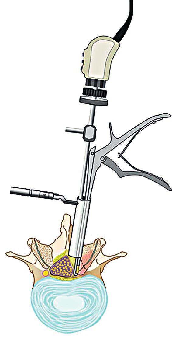 Tijdens de operatie wordt de zenuw vrij gelegd door het bot, dat de vernauwing of beklemming veroorzaakt, te verwijderen.