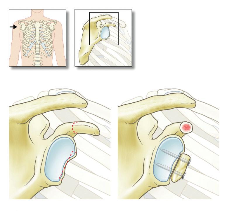Afbeelding 5 Latarjet procedure Dit botblokje is afkomstig van de processus coracoideus, een botstructuur vlakbij de kom van de schouder.