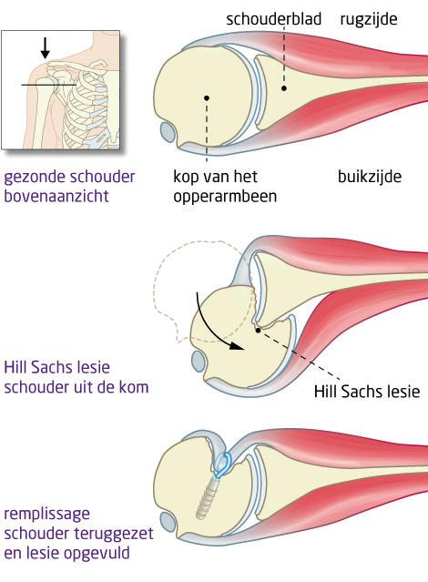 Hierdoor raakt de schouder in de verschillende bewegingsrichtingen instabiel.