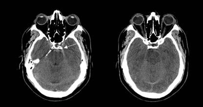 Figuur 1. Twee voorbeelden van perimesencephale bloedingen. A. De kern van de bloeding is aan de voorzijde van de hersenstam gelokaliseerd (zie pijl).