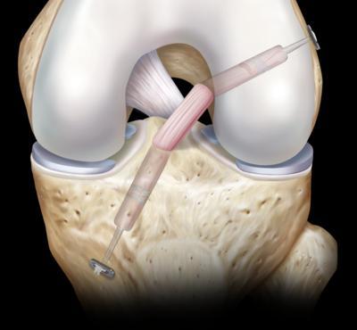 Methodes chirurgische vervanging kruisband In het Orthopedisch Centrum wordt gebruik gemaakt van de nieuwste methodes van voorste kruisbandchirurgie. Hierbij gebruiken we één van de hamstrings.