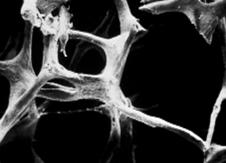 De meest voorkomende breuken als gevolg van osteoporose zijn pols-, heup- en wervelbreuken. Osteoporose op zich veroorzaakt geen pijn. De pijn treedt pas op bij de gevolgen ervan, nl.