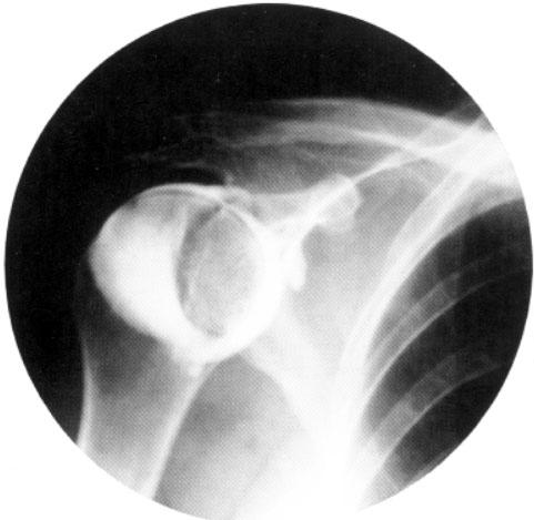 De recessus axillaris is goed zichtbaar (4) Figuur 25 Arthrogram van een primaire frozen shoulder rechts Er is